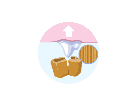 a szemcse eltávolítja a felrakódást - illusztráció